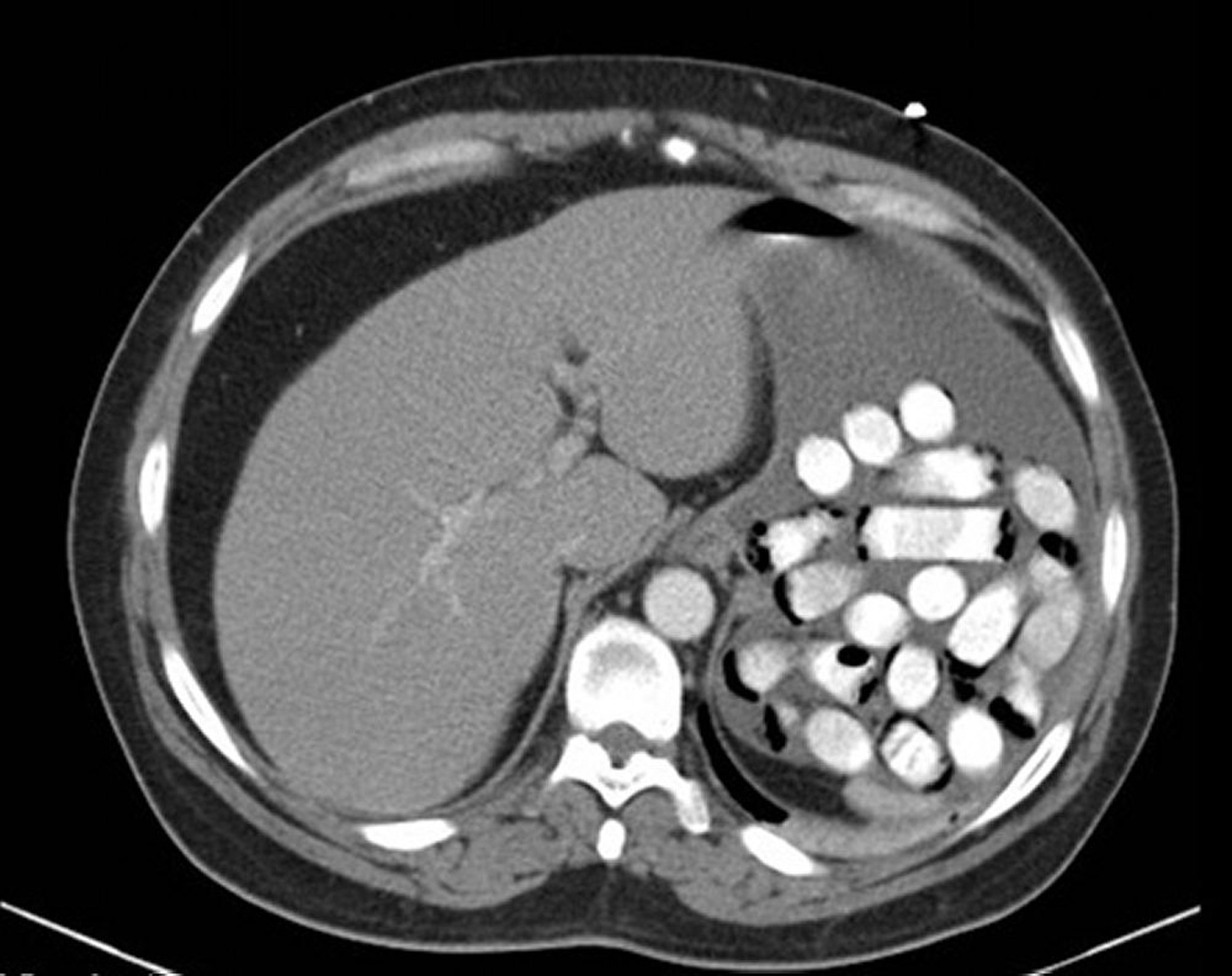 Cuerpo extraño en el estómago (tomografía computarizada)