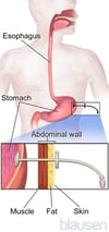 Gastrostomy Tube