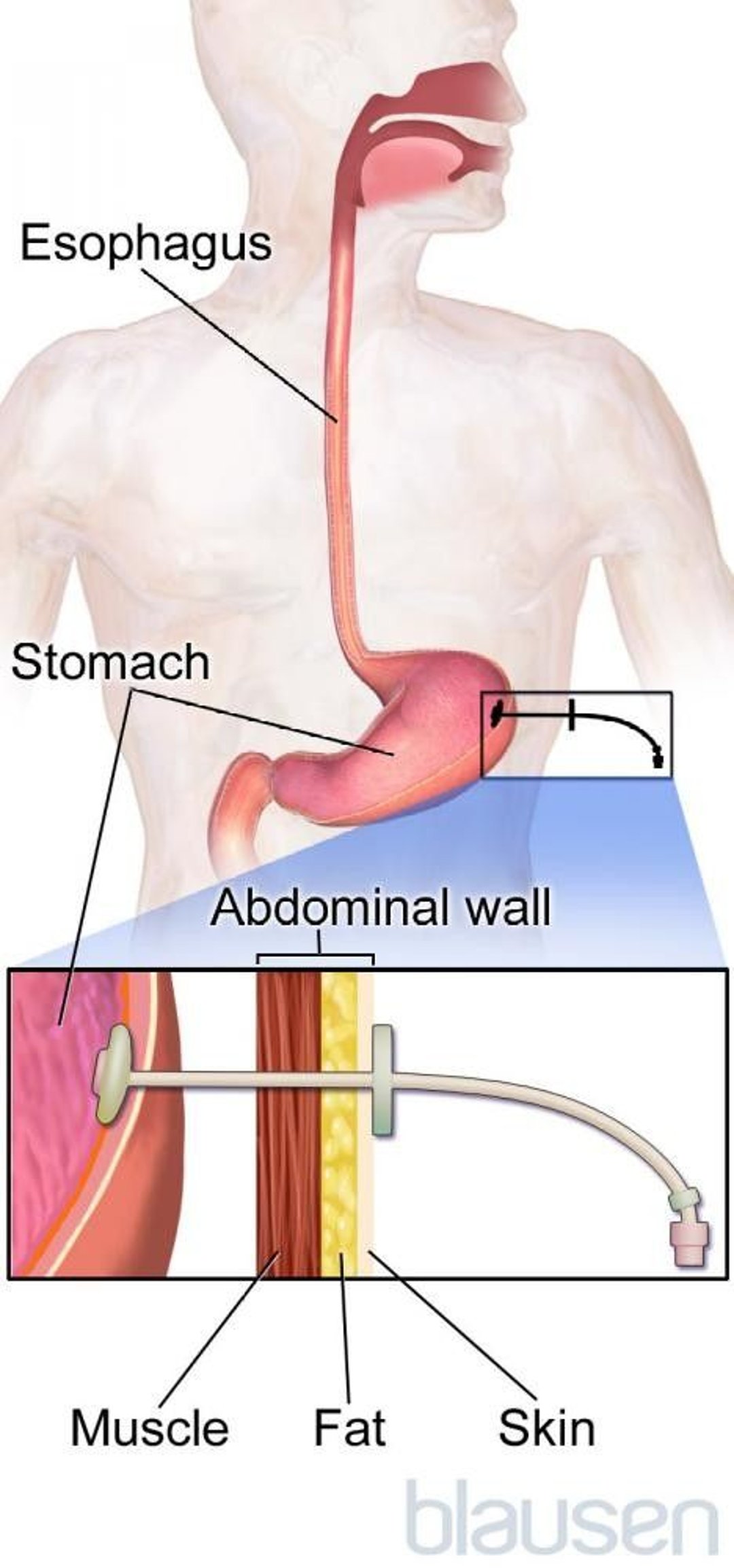 Gastrostomy Tube