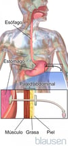 Tubo de gastrostomía