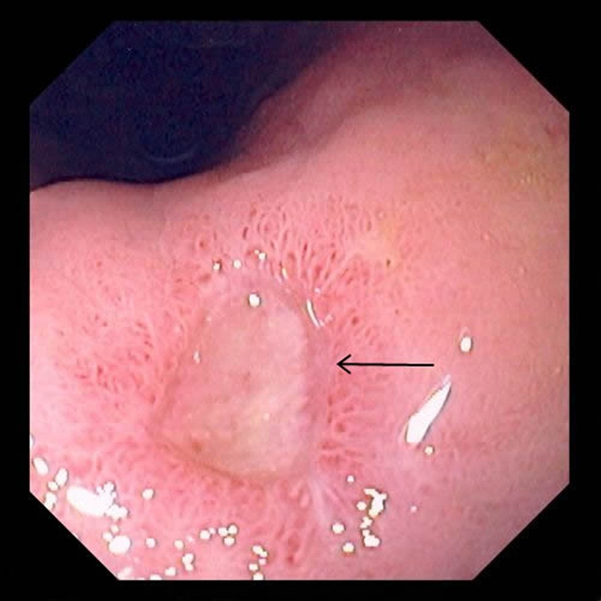 Gastric Ulcer