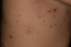 Molusco contagioso