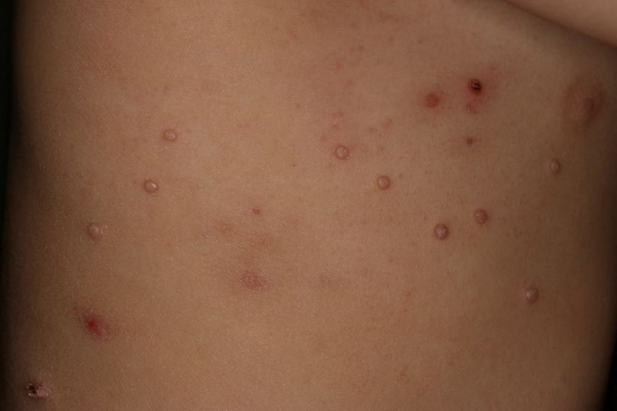 Molluscum contagiosum