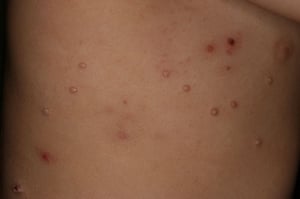 Molusco Contagioso