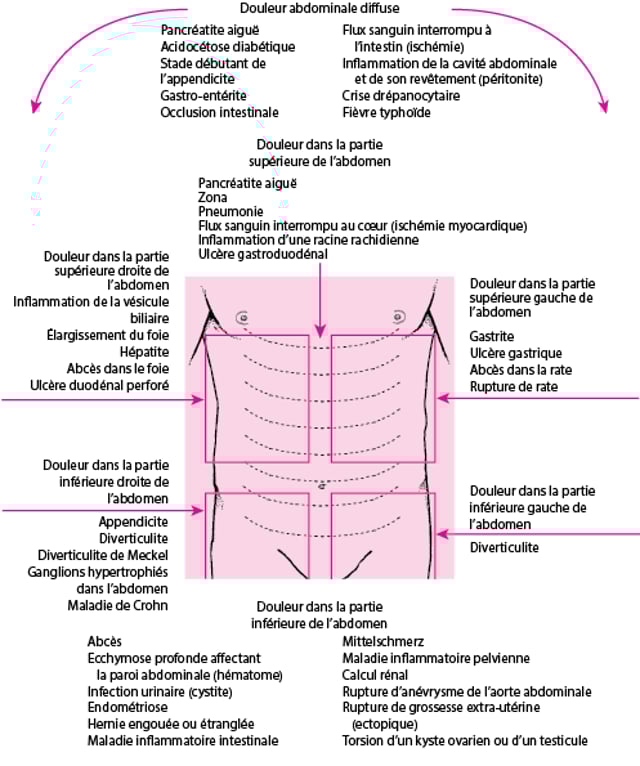Douleur abdominale aiguë Troubles digestifs Manuels Merck pour le grand public