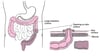 Understanding Colostomy