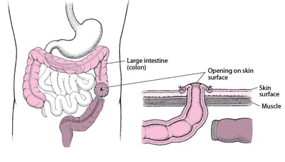 Understanding Colostomy