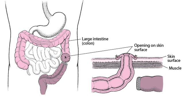 Image:Understanding Colostomy-Merck Manual Consumer Version