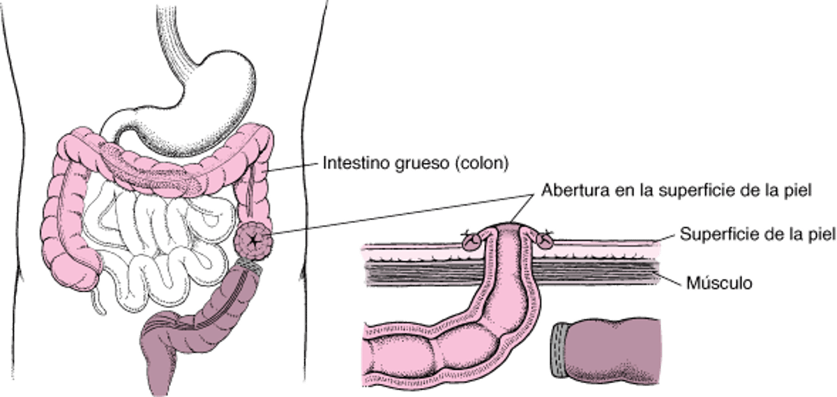 Qué es la colostomía