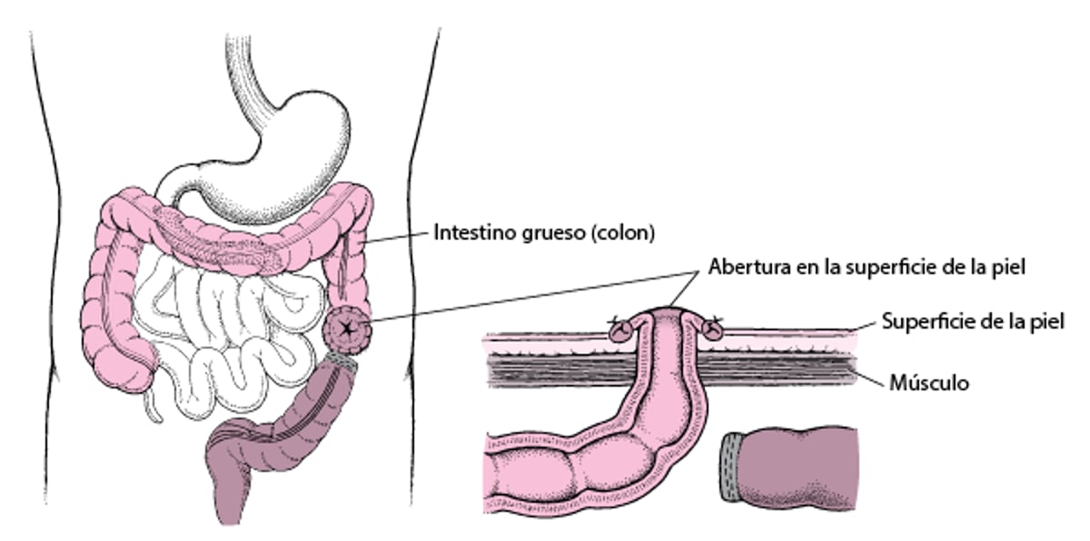 Qué es la colostomía