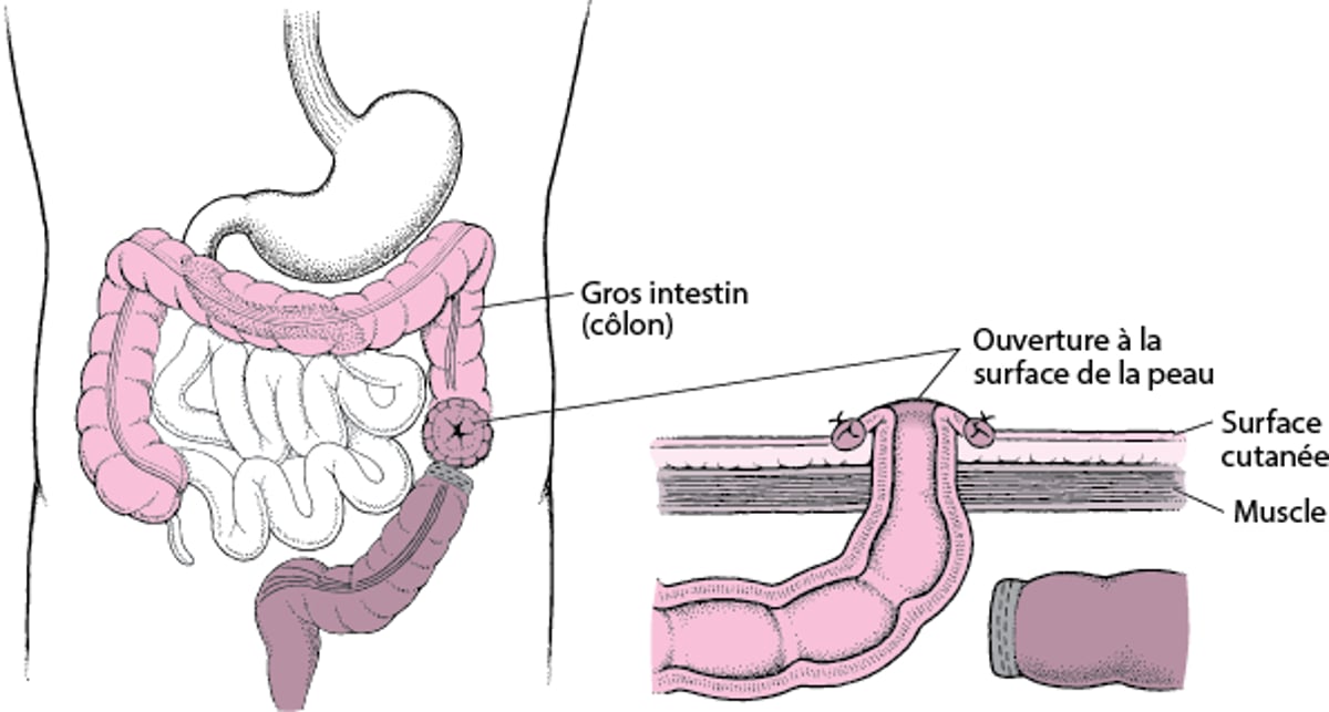 Comprendre la colostomie