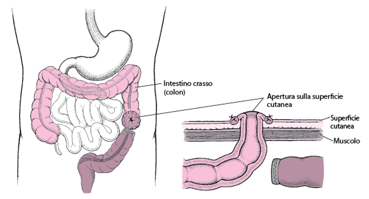 Informazioni sulla colostomia