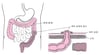 결장조루술에 대한 이해