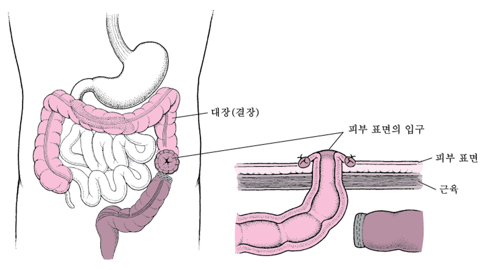 결장조루술에 대한 이해