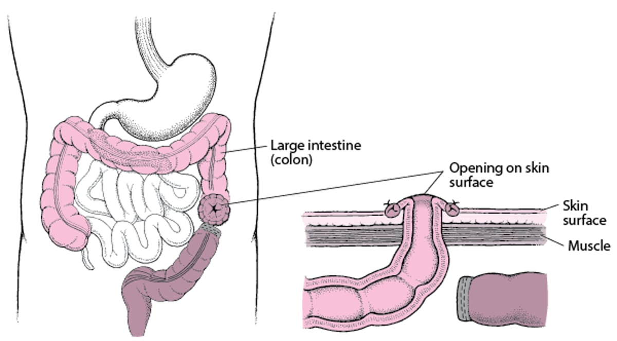 了解结肠造口术