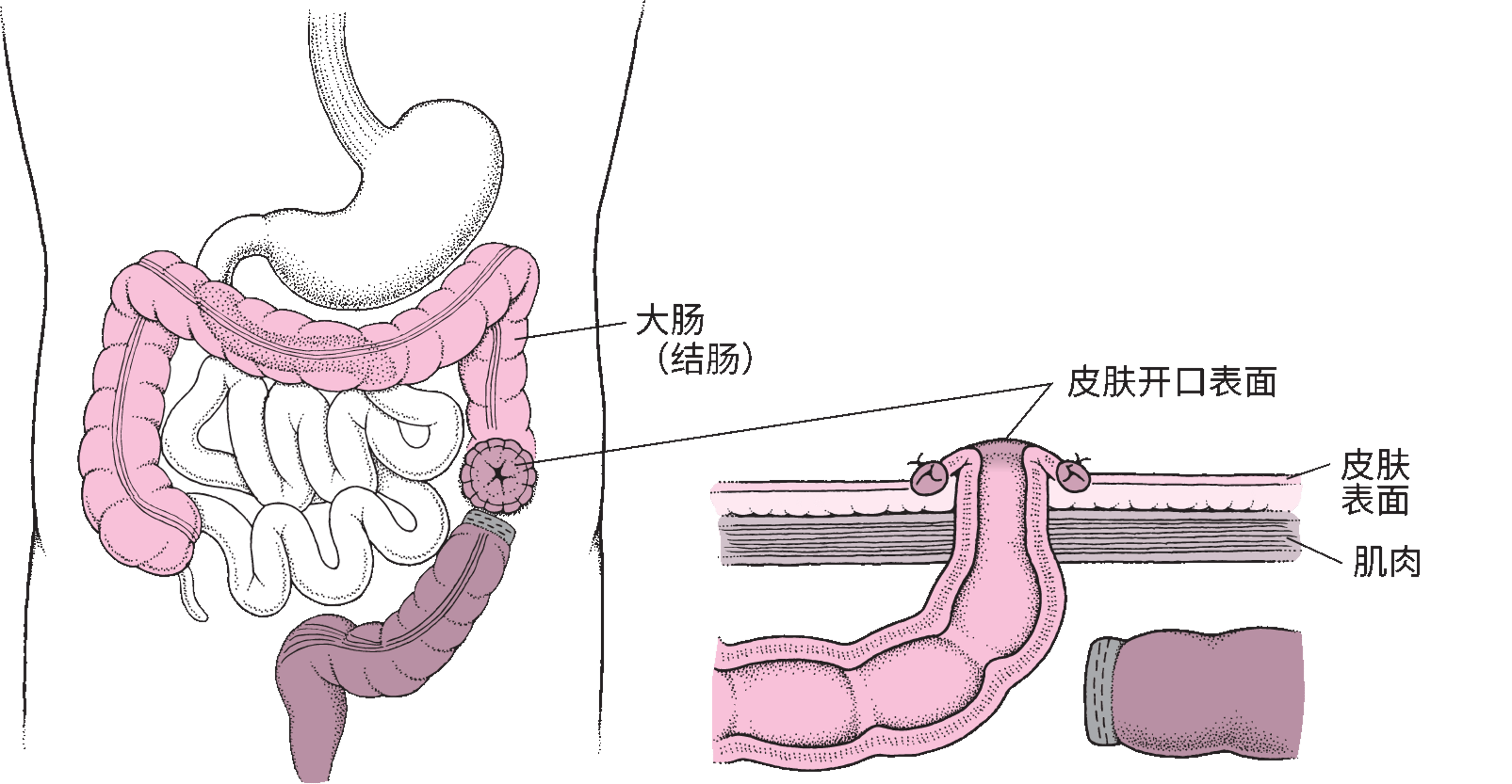 了解结肠造口术