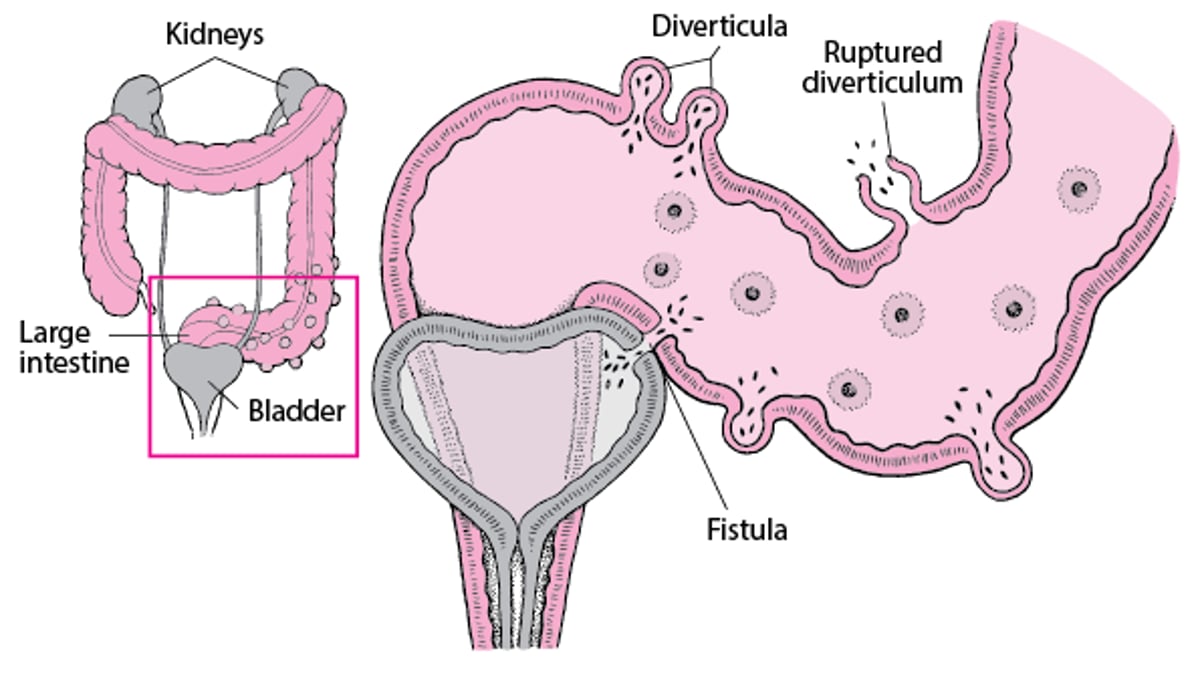 Complications of Diverticulitis