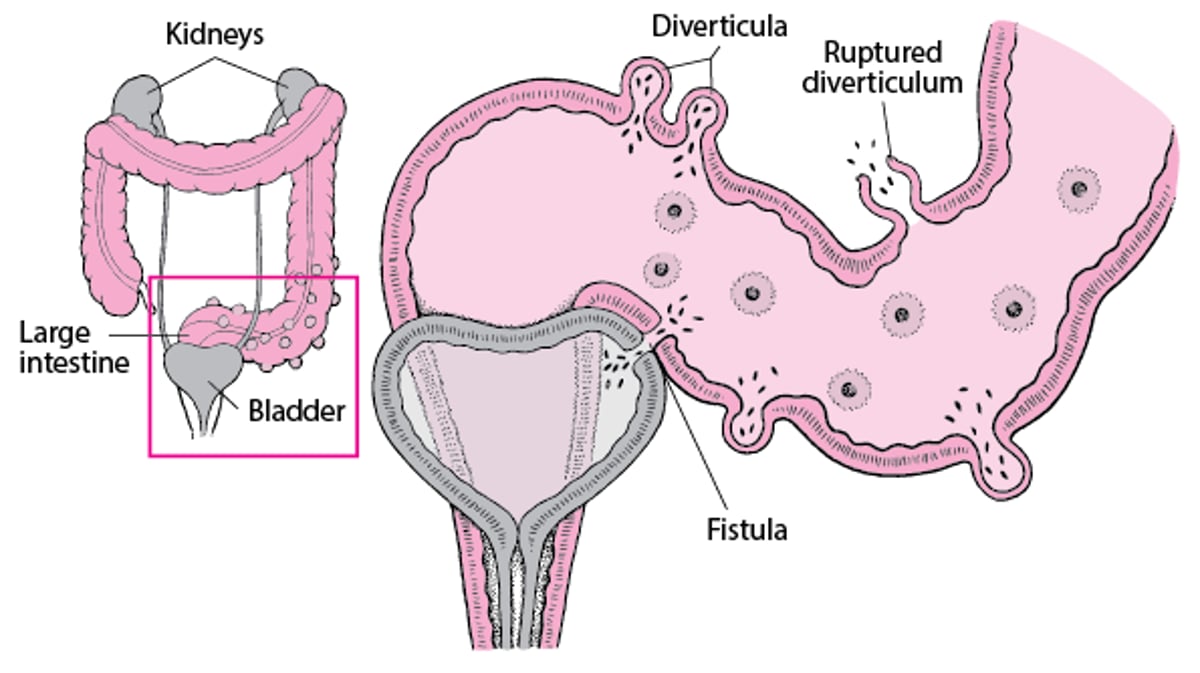 Complicaciones de la diverticulitis