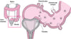 Complications de la diverticulite