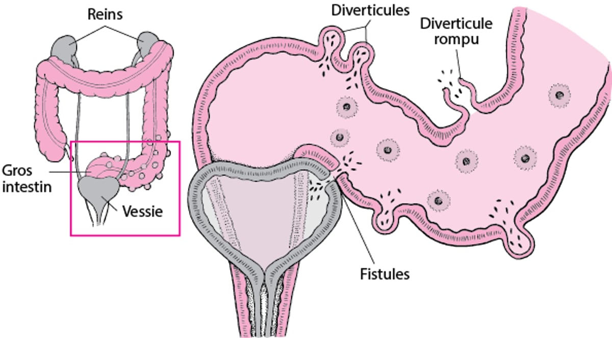 Complications de la diverticulite