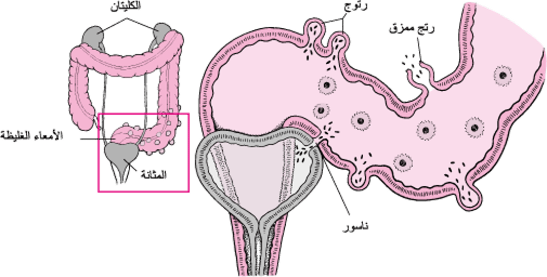 بعض مُضَاعَفات التهاب الرَّتج