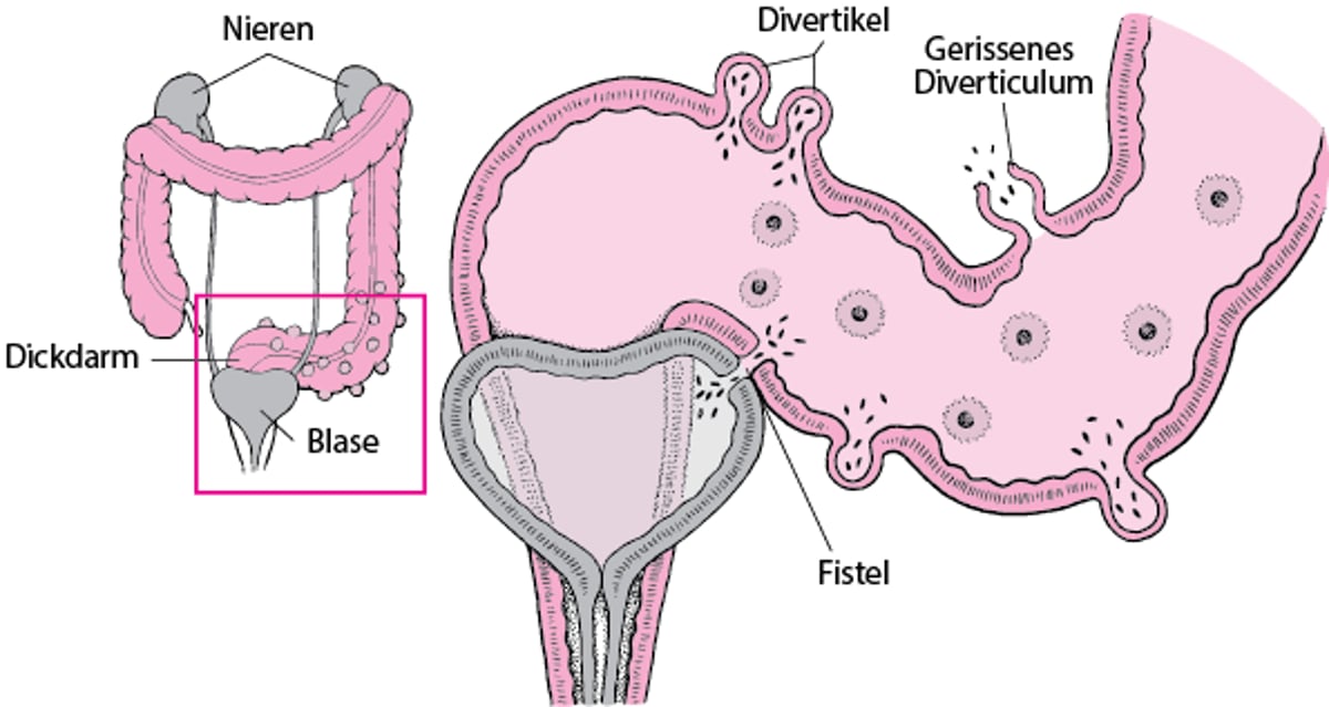 Einige Komplikationen bei Divertikulitis