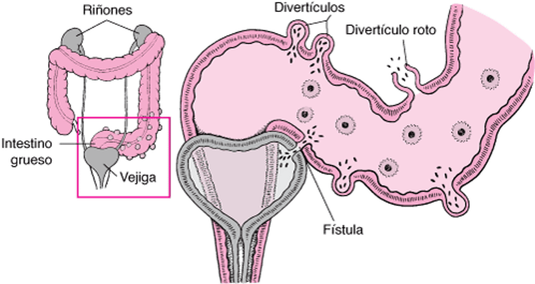 Algunas complicaciones de la diverticulitis