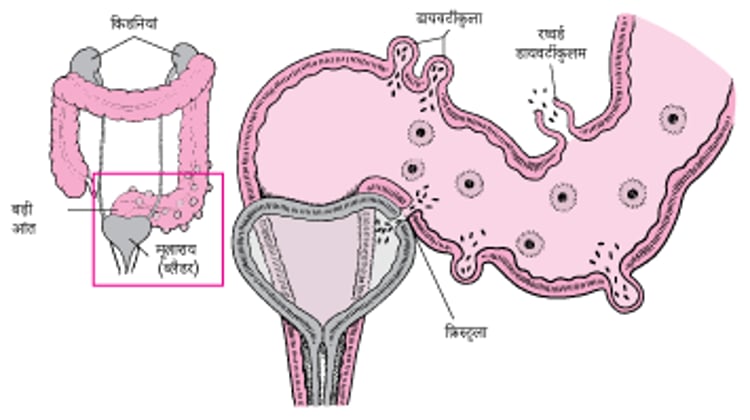 डायवर्टीकुलाइटिस की कुछ जटिलताएं