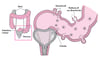 Alcune complicanze della diverticolite