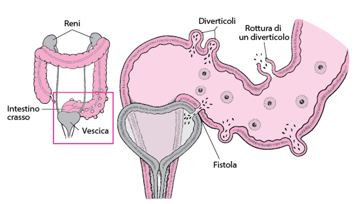 Alcune complicanze della diverticolite