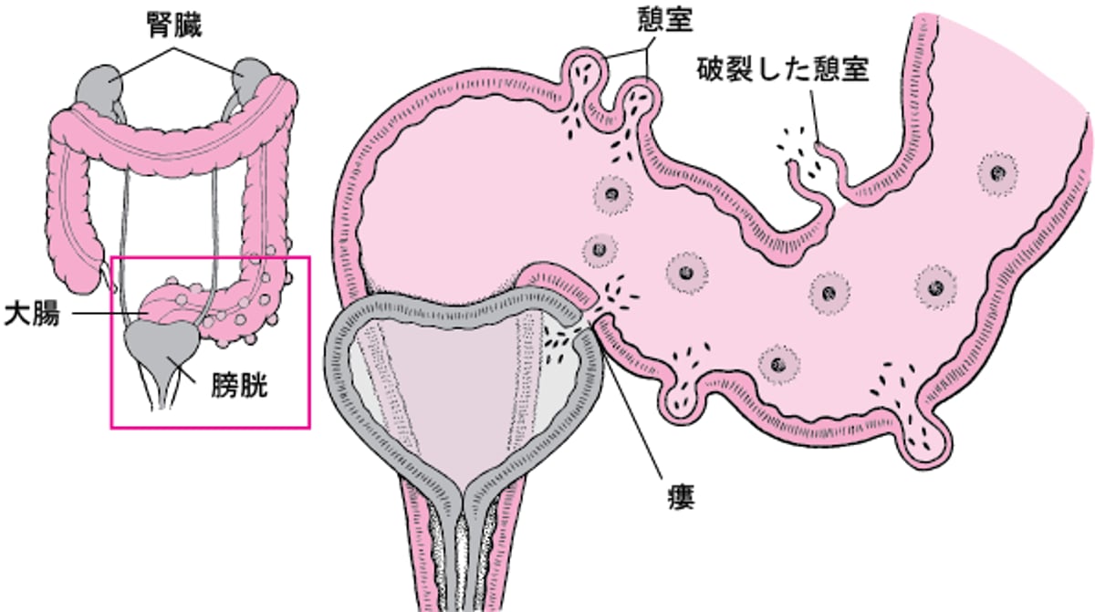 <ruby >憩室炎<rt >けいしつえん</rt></ruby>の<ruby >合併症<rt >がっぺいしょう</rt></ruby>