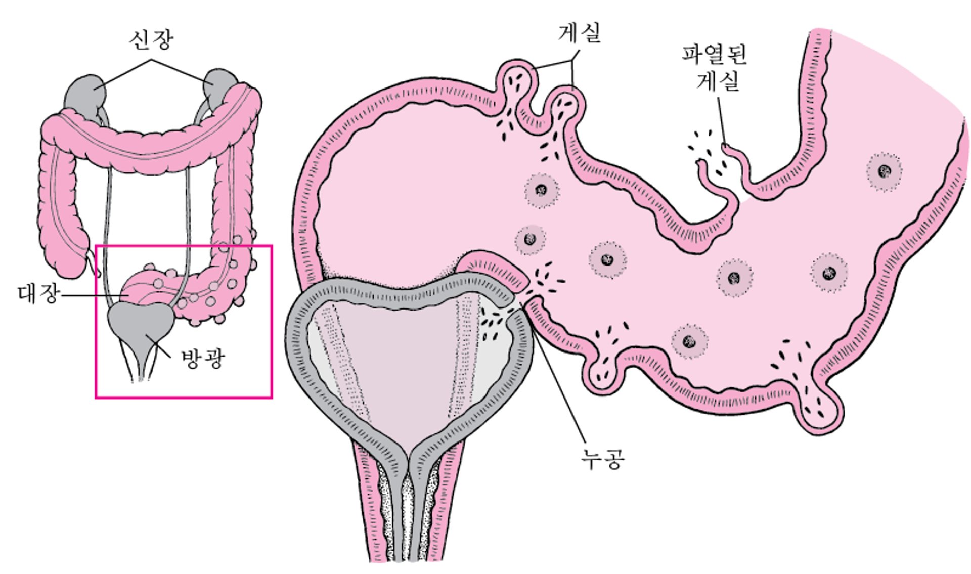 게실염의 일부 합병증
