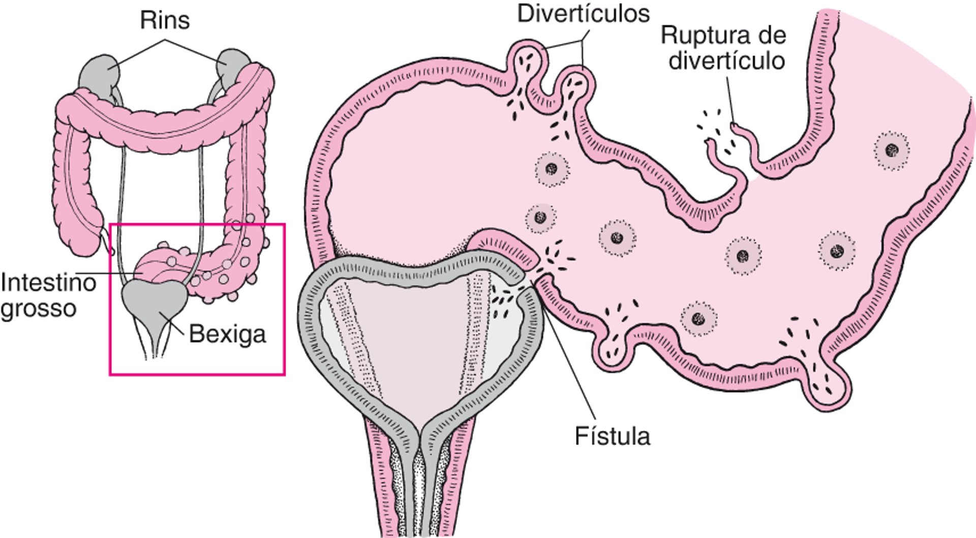 Algumas complicações da diverticulite
