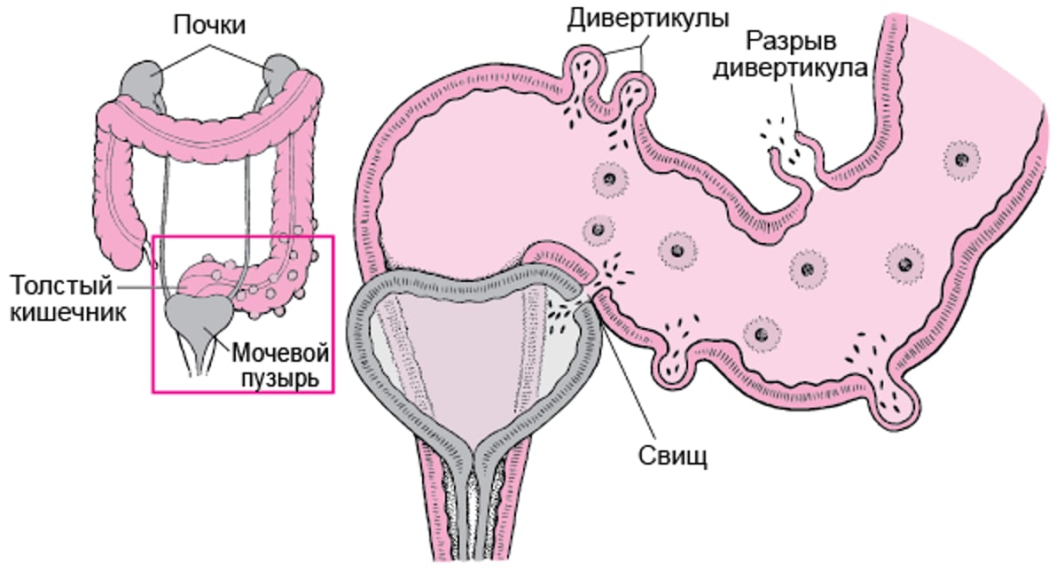 Некоторые осложнения дивертикулита