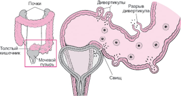 Некоторые осложнения дивертикулита