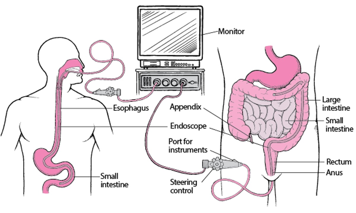 Viewing the Digestive Tract With an Endoscope