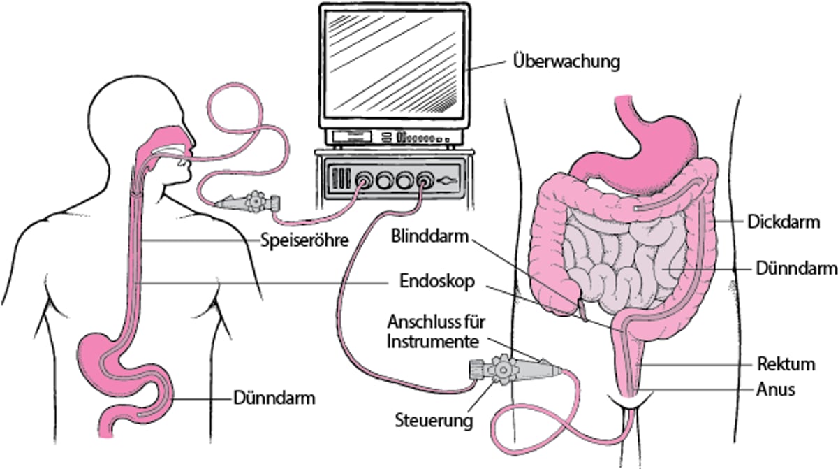 Betrachtung des Verdauungstrakts mit einem Endoskop