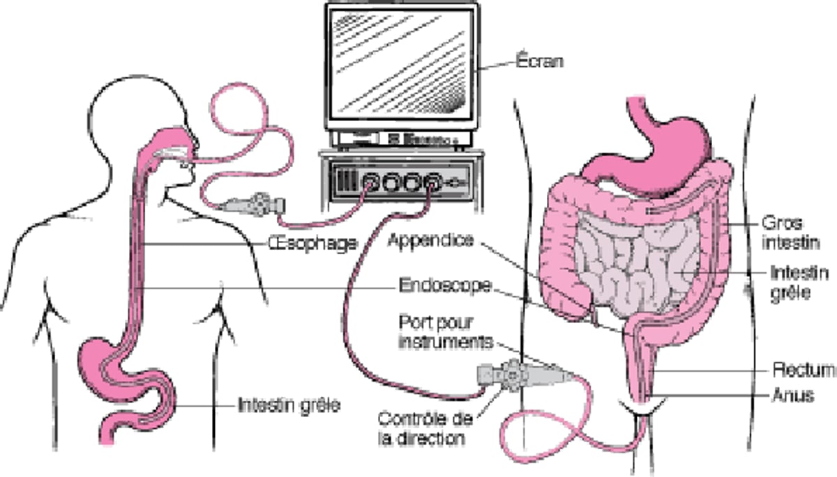 Examen du tube digestif par un endoscope