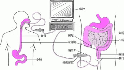 通过内镜检查消化道