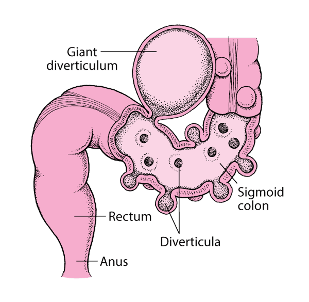 Large Intestine with Diverticula