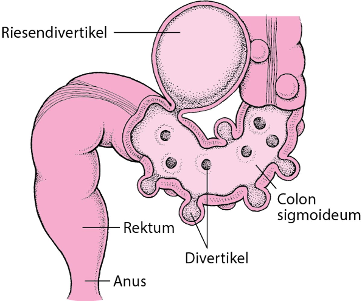 Dickdarm mit Divertikeln