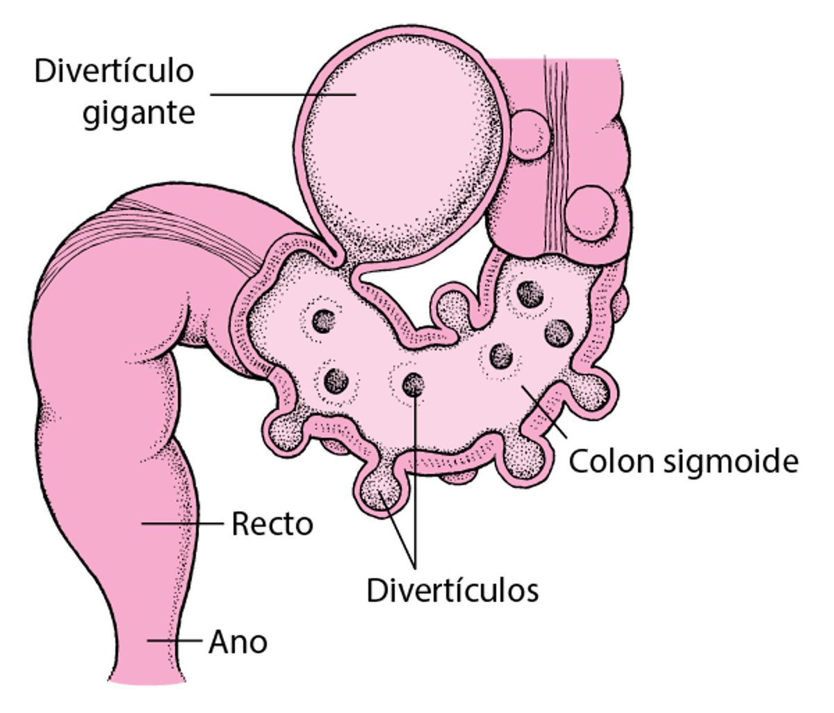 Intestino grueso con divertículos