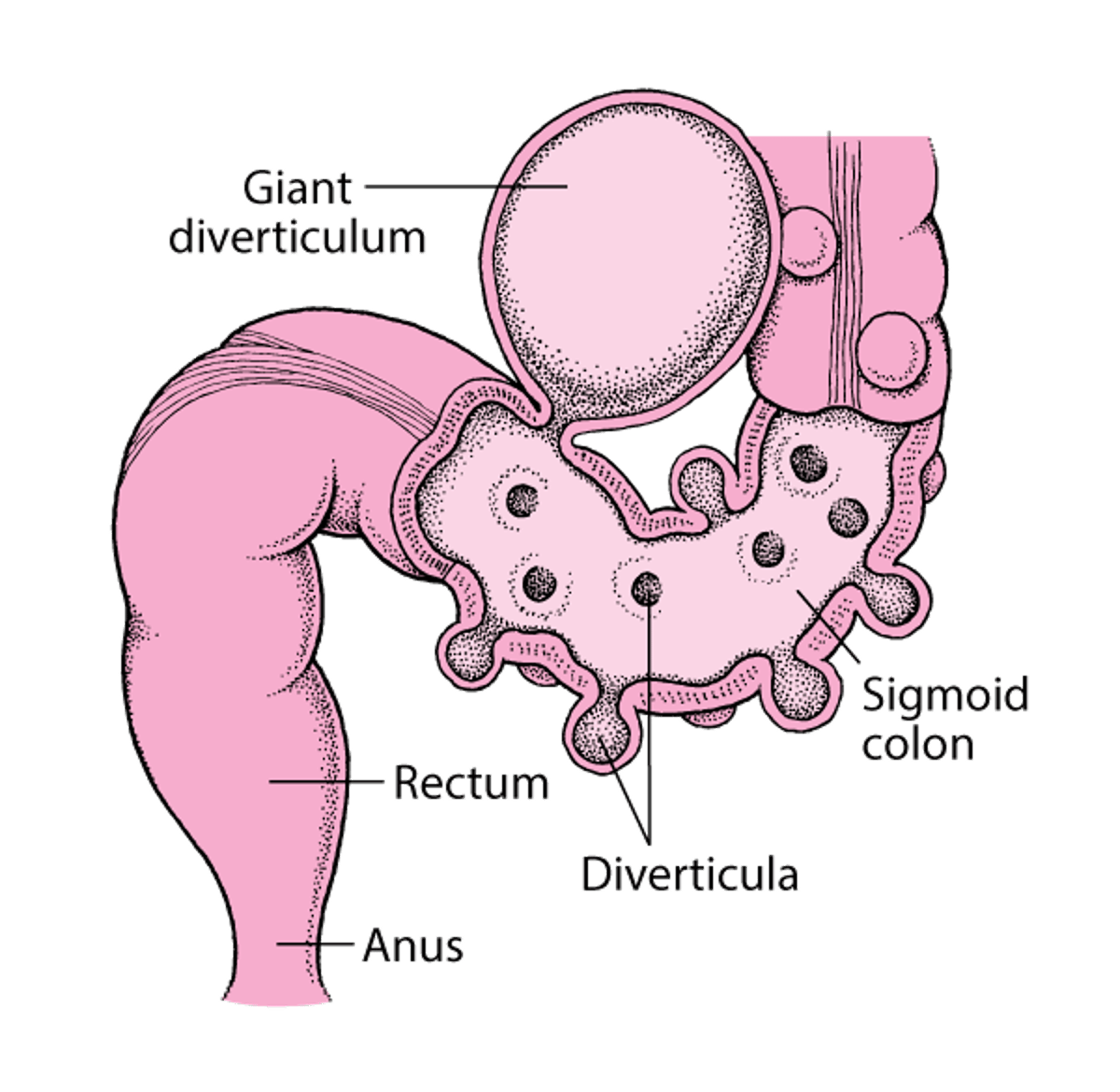 Gros intestin avec des diverticules