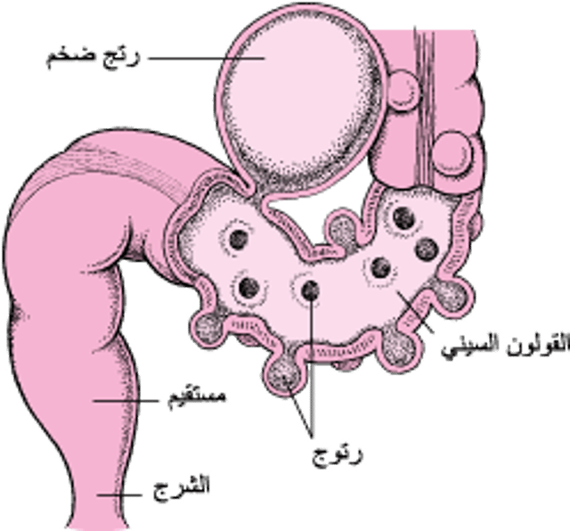 المِعَى الغليظ مع رتوج