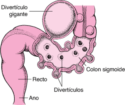 Intestino grueso con divertículos