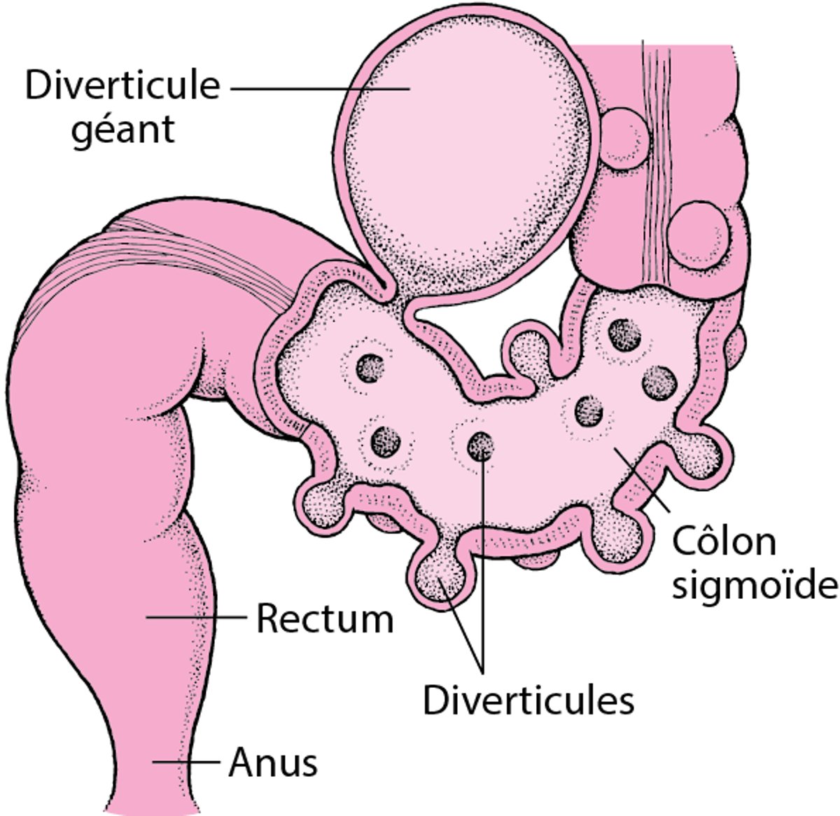 Gros intestin avec des diverticules
