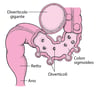 Intestino crasso con diverticoli