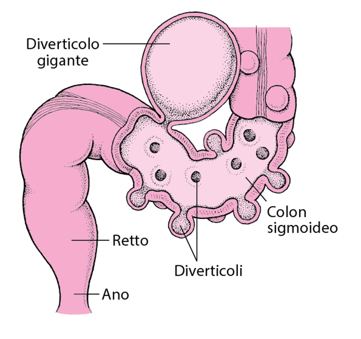 Intestino crasso con diverticoli