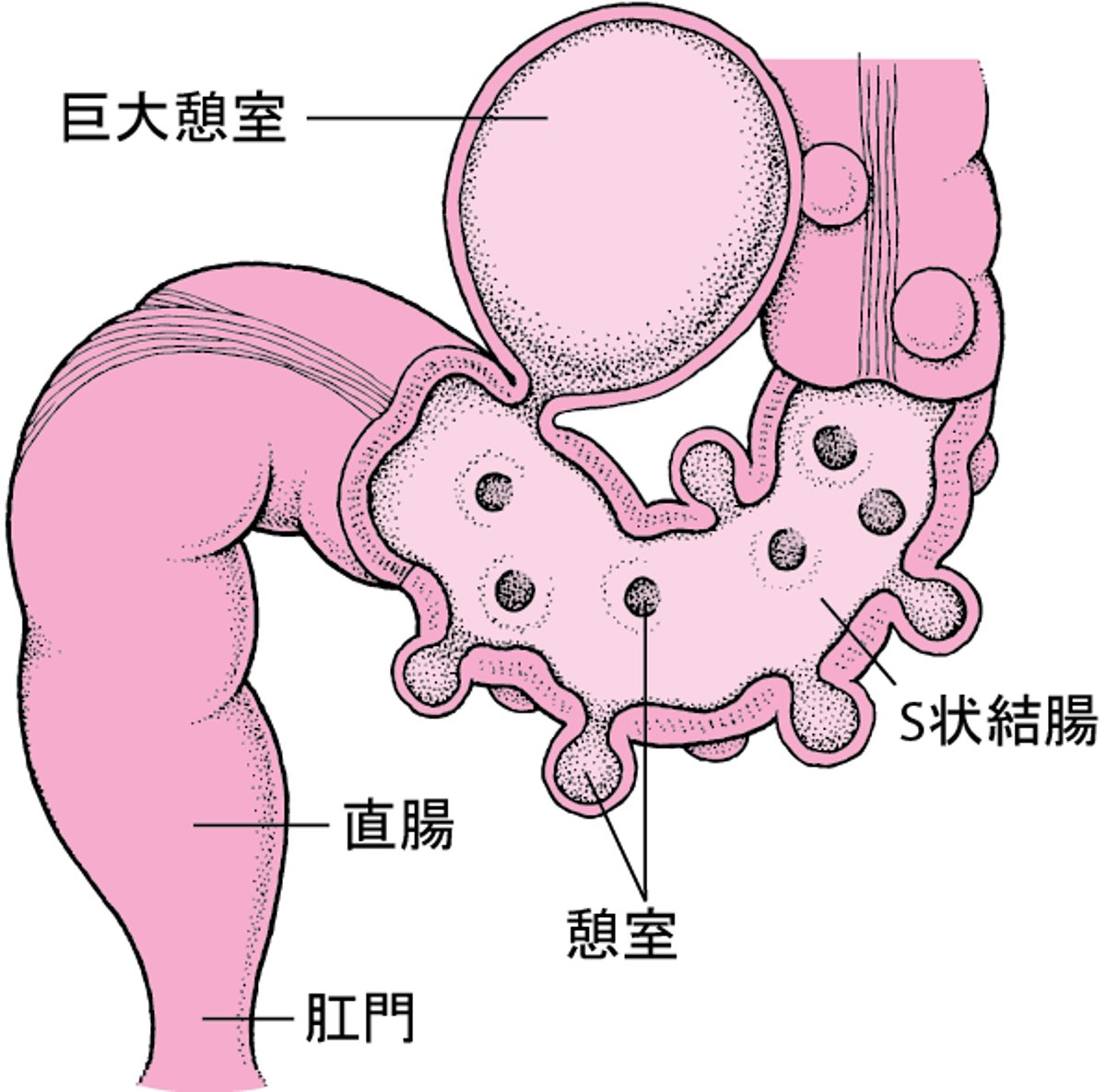 <ruby >憩室<rt >けいしつ</rt></ruby>ができた<ruby >大腸<rt >だいちょう</rt></ruby>
