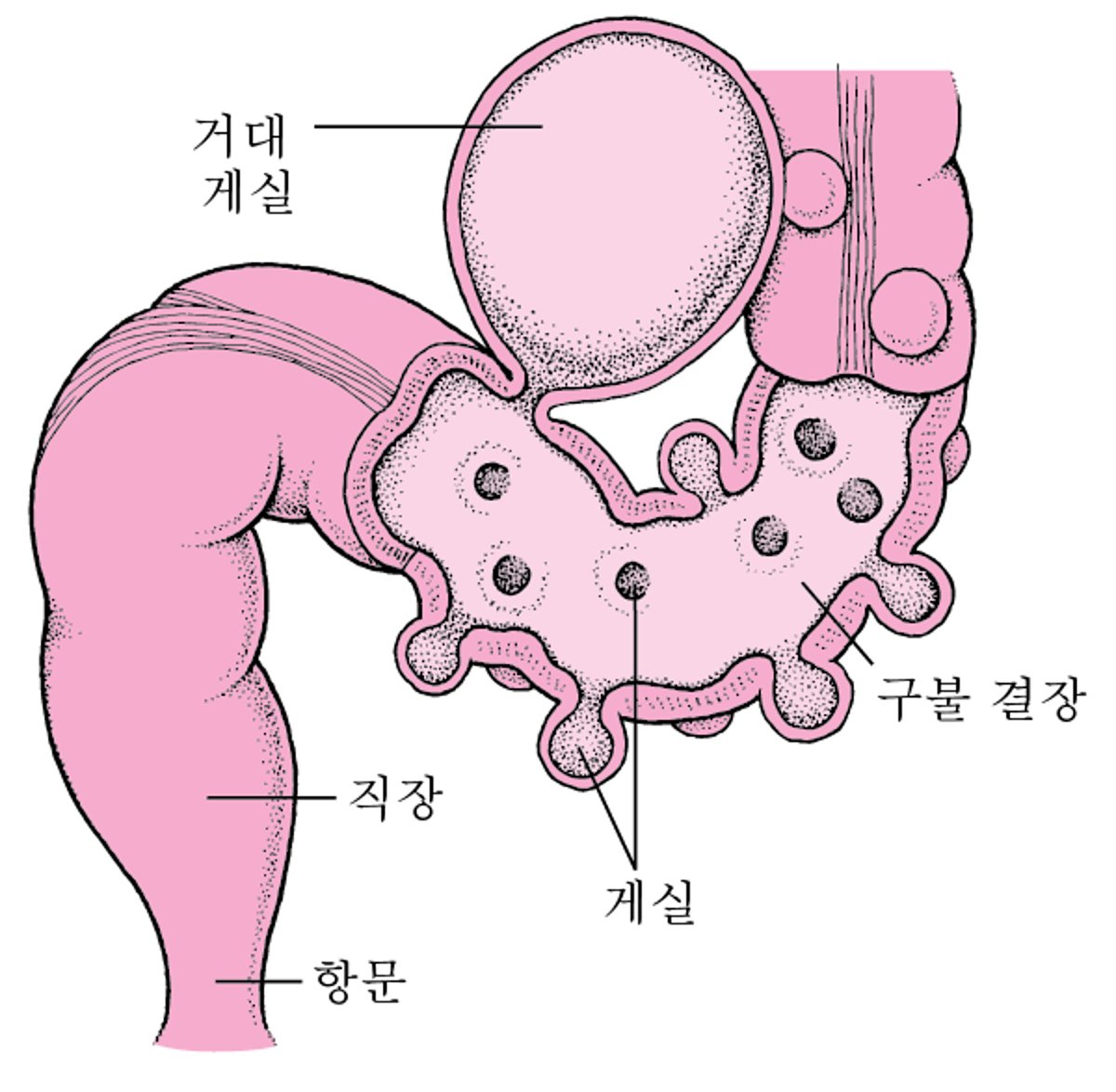 게실이 있는 대장